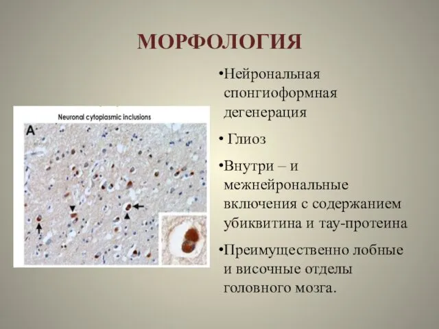 МОРФОЛОГИЯ Нейрональная спонгиоформная дегенерация Глиоз Внутри – и межнейрональные включения