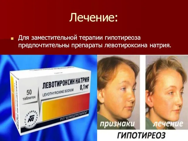 Лечение: Для заместительной терапии гипотиреоза предпочтительны препараты левотироксина натрия.