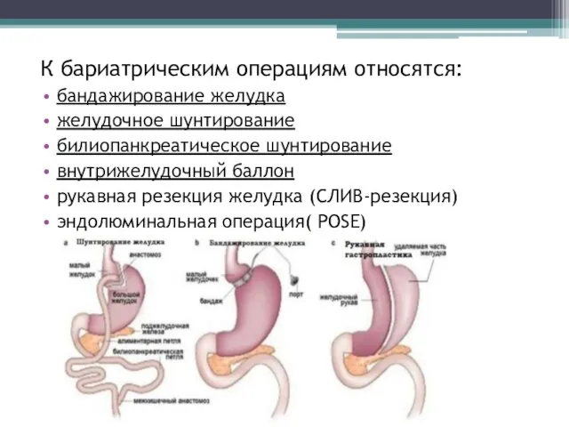 К бариатрическим операциям относятся: бандажирование желудка желудочное шунтирование билиопанкреатическое шунтирование