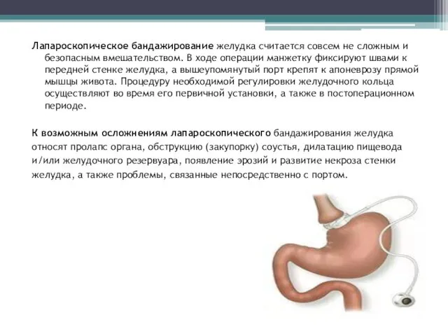 Лапароскопическое бандажирование желудка считается совсем не сложным и безопасным вмешательством.