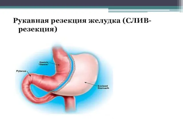 Рукавная резекция желудка (СЛИВ-резекция)