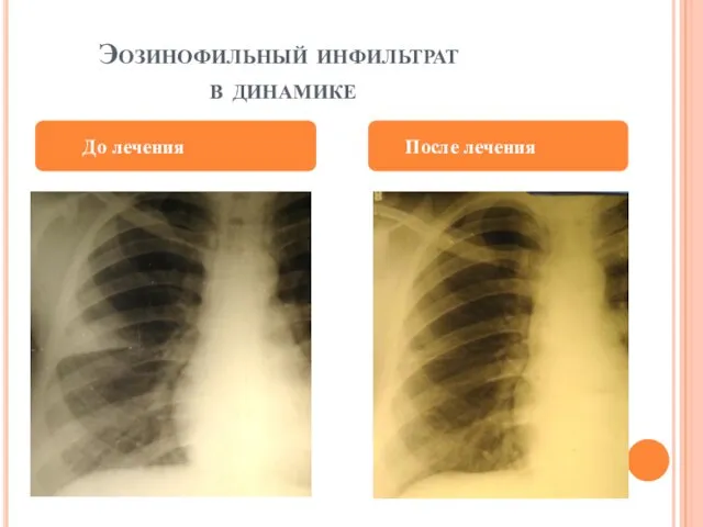 Эозинофильный инфильтрат в динамике До лечения После лечения