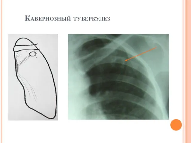 Кавернозный туберкулез