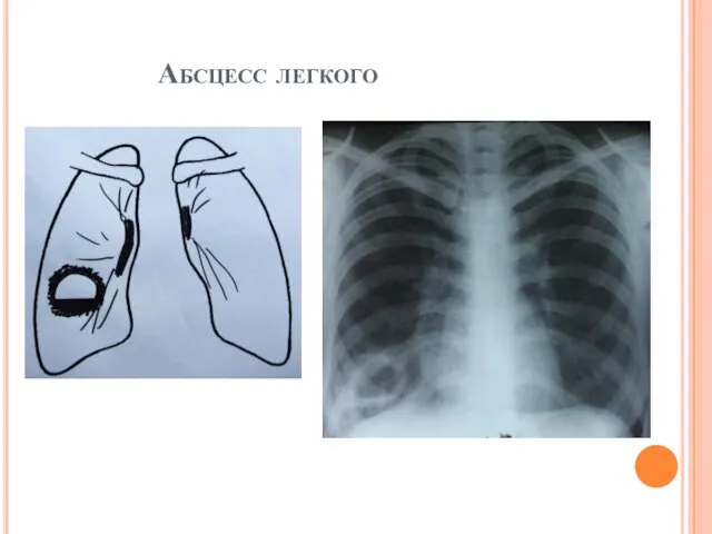 Абсцесс легкого