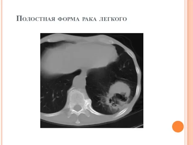 Полостная форма рака легкого