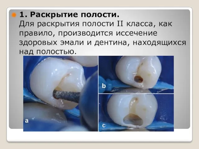 1. Раскрытие полости. Для раскрытия полости II класса, как правило,