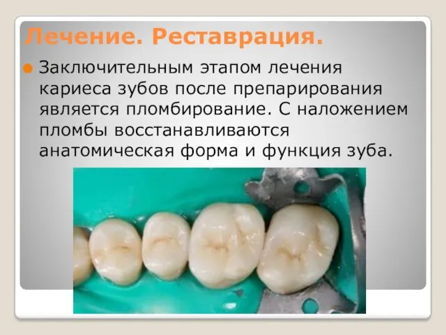 Лечение. Реставрация. Заключительным этапом лечения кариеса зубов после препарирования является пломбирование. С наложением