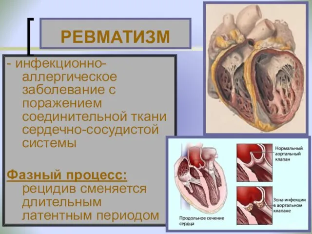 - инфекционно-аллергическое заболевание с поражением соединительной ткани сердечно-сосудистой системы Фазный