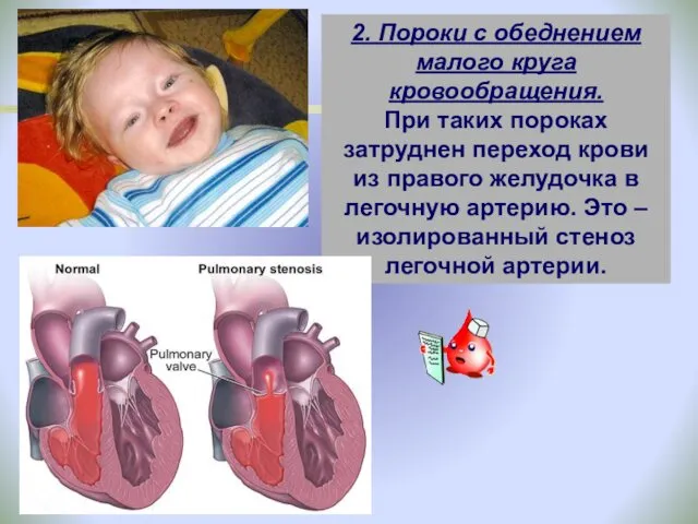 2. Пороки с обеднением малого круга кровообращения. При таких пороках