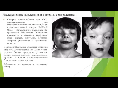 Синдром Аарскога-Скотта или САС, фациогентиальная или фациодигитогенитальная дисплазия, лице-пальце-генитальный синдром