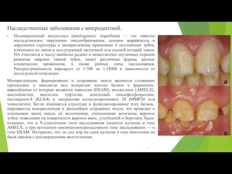 Наследственные заболевания с микродентией. Несовершенный амелогенез (amelogenesis imperfecta) — это