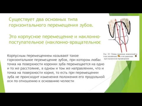 Существует два основных типа горизонтального перемещения зубов. Это корпусное перемещение