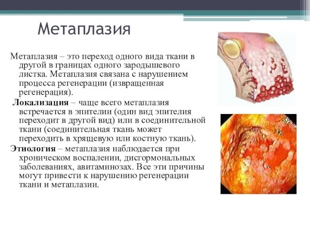 Метаплазия Метаплазия – это переход одного вида ткани в другой