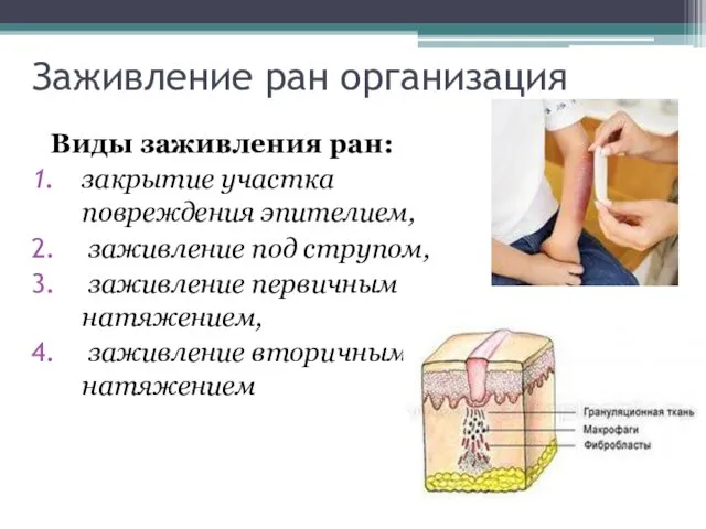 Заживление ран организация Виды заживления ран: закрытие участка повреждения эпителием,