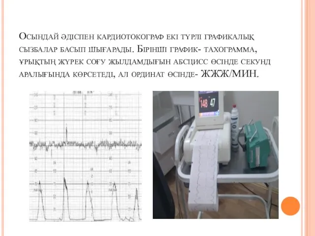 Осындай әдіспен кардиотокограф екі түрлі графикалық сызбалар басып шығарады. Бірінші