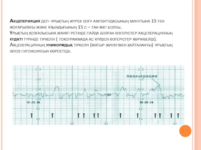 Акцелерияция деп- ұрықтың жүрек соғу амплитудасының минутына 15 тен жоғарылауы және ұзындығының 15