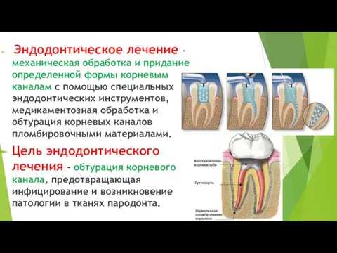 Эндодонтическое лечение - механическая обработка и придание определенной формы корневым