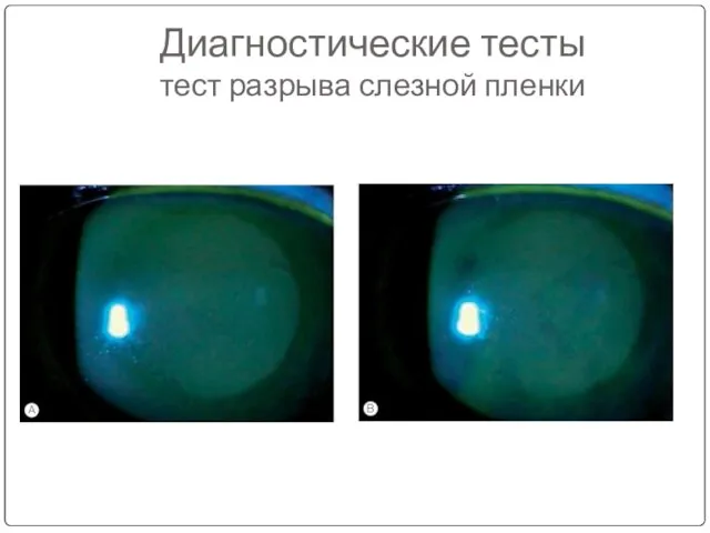 Диагностические тесты тест разрыва слезной пленки