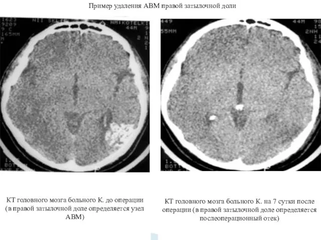 Пример удаления АВМ правой затылочной доли КТ головного мозга больного
