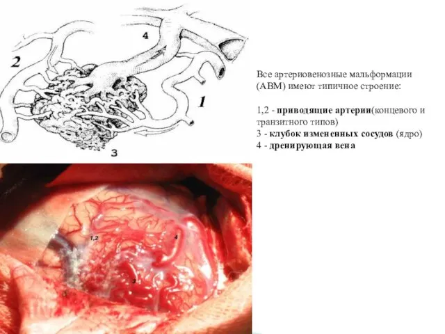 Все артериовенозные мальформации (АВМ) имеют типичное строение: 1,2 - приводящие