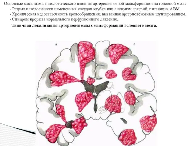 Основные механизмы патологического влияния артериовенозной мальформации на головной мозг: -