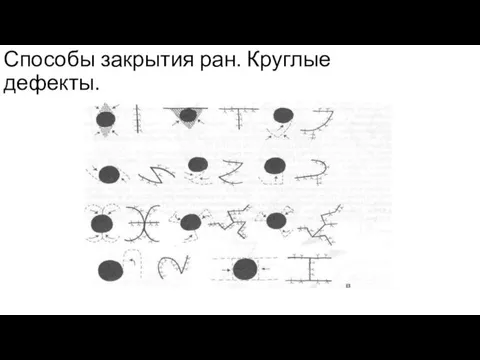 Способы закрытия ран. Круглые дефекты.