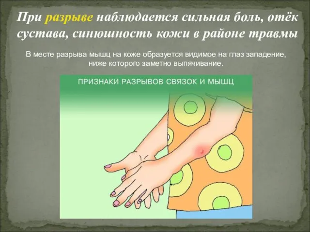 При разрыве наблюдается сильная боль, отёк сустава, синюшность кожи в