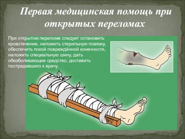 Первая медицинская помощь при открытых переломах При открытом переломе следует