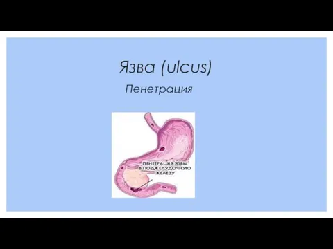 Язва (ulcus) Пенетрация