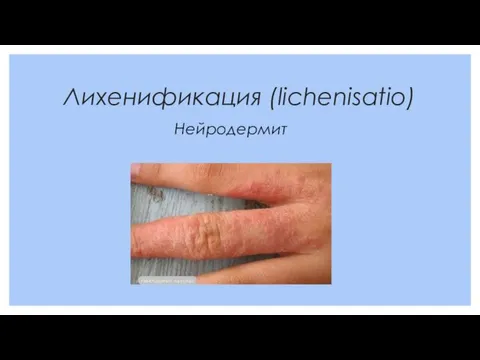 Лихенификация (lichenisatio) Нейродермит
