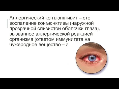 Аллергический конъюнктивит – это воспаление конъюнктивы (наружной прозрачной слизистой оболочки