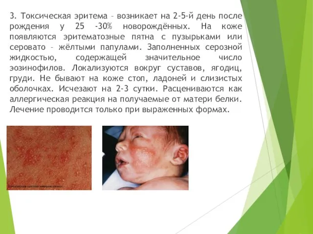 3. Токсическая эритема – возникает на 2-5-й день после рождения