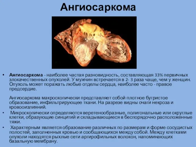 Ангиосаркома Ангиосаркома - наиболее частая разновидность, составляющая 33% первичных злокачественных