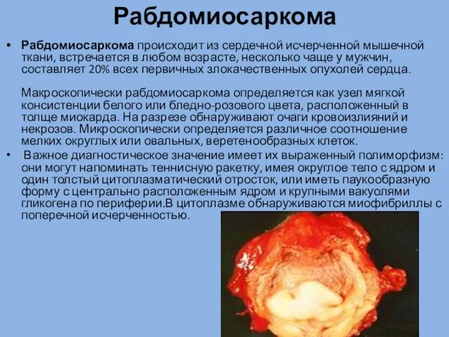 Рабдомиосаркома Рабдомиосаркома происходит из сердечной исчерченной мышечной ткани, встречается в