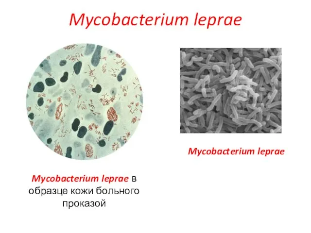 Mycobacterium leprae Mycobacterium leprae в образце кожи больного проказой Mycobacterium leprae