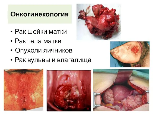 Рак шейки матки Рак тела матки Опухоли яичников Рак вульвы и влагалища Онкогинекология