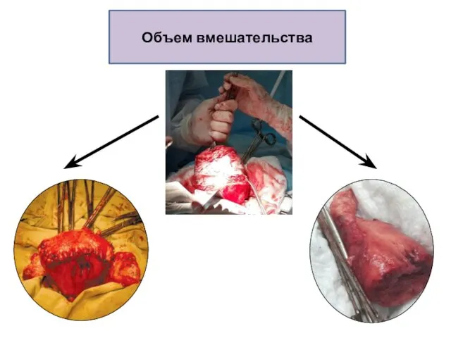 Объем вмешательства