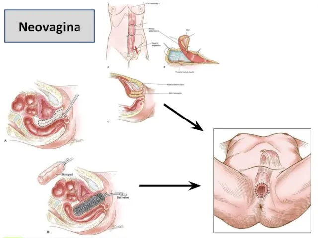 Neovagina