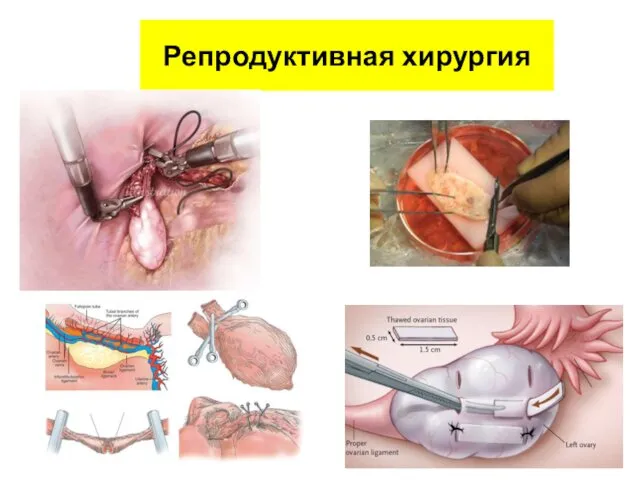 Репродуктивная хирургия