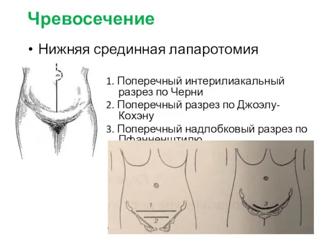 Чревосечение Нижняя срединная лапаротомия 1. Поперечный интерилиакальный разрез по Черни