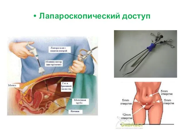 Лапароскопический доступ