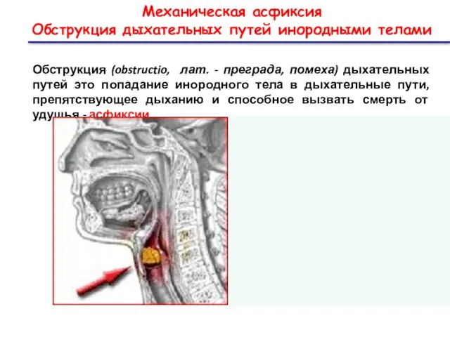 Механическая асфиксия Обструкция дыхательных путей инородными телами Обструкция (obstructio, лат.