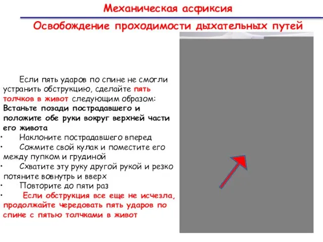Механическая асфиксия Освобождение проходимости дыхательных путей