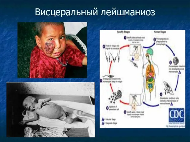 Висцеральный лейшманиоз