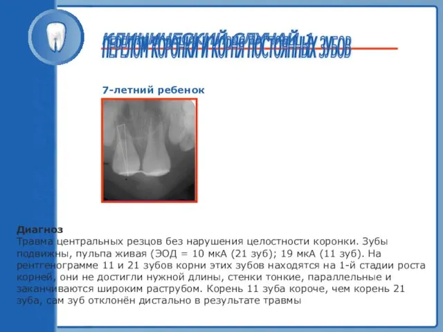 ТРАВМА ЗУБА КЛИНИЧЕСКИЙ СЛУЧАЙ 1 ПЕРЕЛОМ КОРОНКИ И КОРНЯ ПОСТОЯННЫХ ЗУБОВ 7-летний ребенок