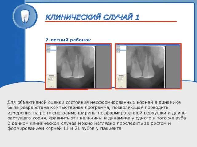 ТРАВМА ЗУБА 7-летний ребенок Для объективной оценки состояния несформированных корней в динамике была