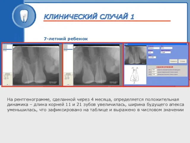 ТРАВМА ЗУБА 7-летний ребенок На рентгенограмме, сделанной через 4 месяца, определяется положительная динамика