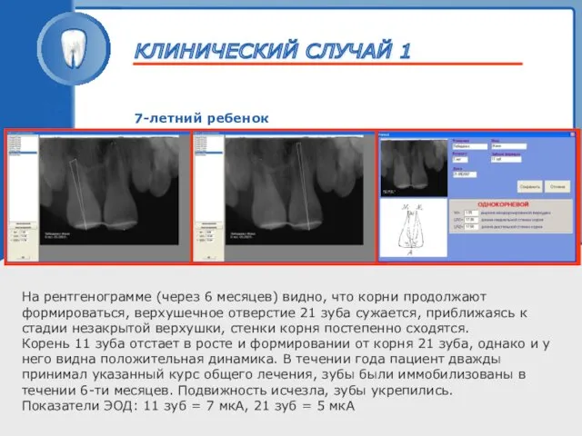 ТРАВМА ЗУБА 7-летний ребенок На рентгенограмме (через 6 месяцев) видно, что корни продолжают