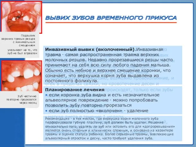 ТРАВМА ЗУБА Ушиб и подвывих. Ушиб ‑ травма зуба и связки без сдвига,