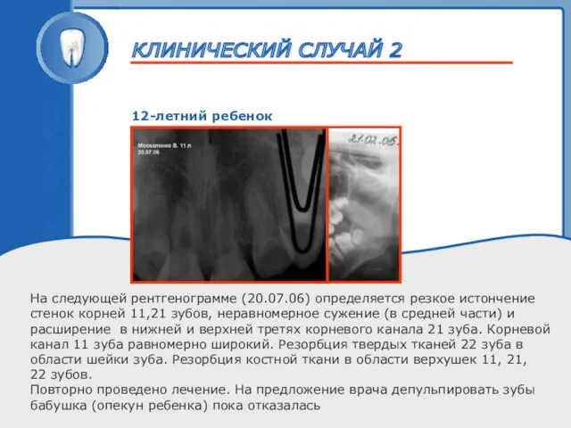 ТРАВМА ЗУБА 12-летний ребенок На следующей рентгенограмме (20.07.06) определяется резкое истончение стенок корней